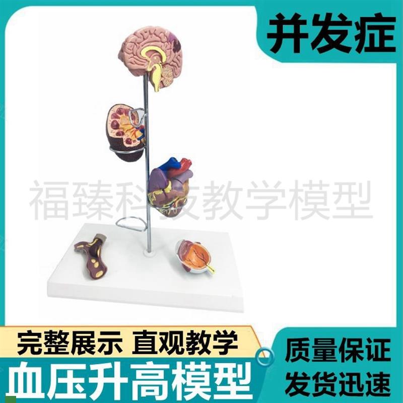 动脉血管压力升高模型脏器受w损并发脑心脏血管眼底肾脏血液循环