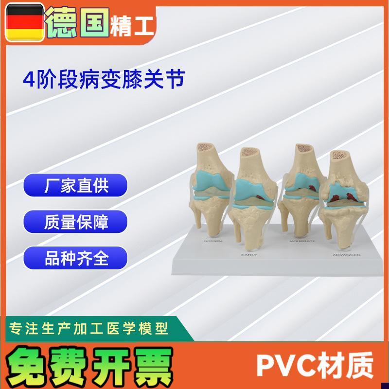 德国】人体4阶段病变膝关节模型生物医学教Z学器材模具