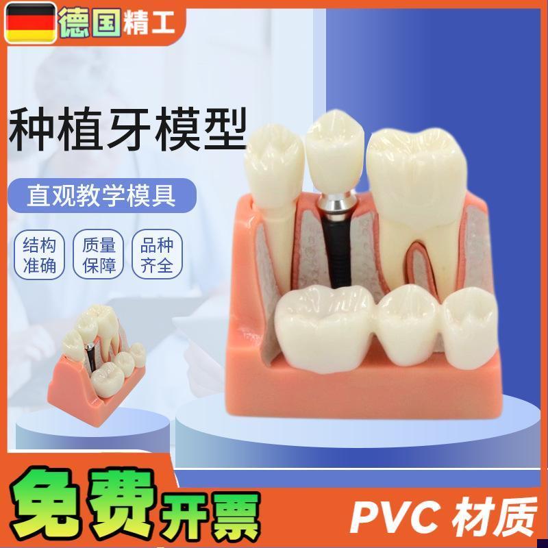德国】种植f牙模型人体口腔牙齿模型透明牙模型牙种植模型