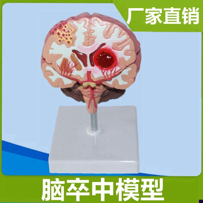 脑卒中模型病理血管神经科医w患人体脑结构模型大脑皮层功能区定