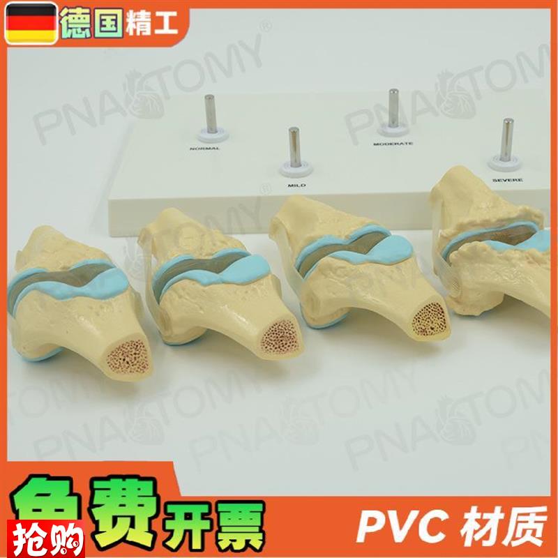 德国】人体膝关节骨骼p/病理模型关节骨质/病变教学膝盖骨外科疼