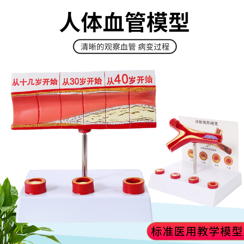 堵塞心血管模型关节血p栓血液浓度脂肪病理粥样硬化人体解剖教具