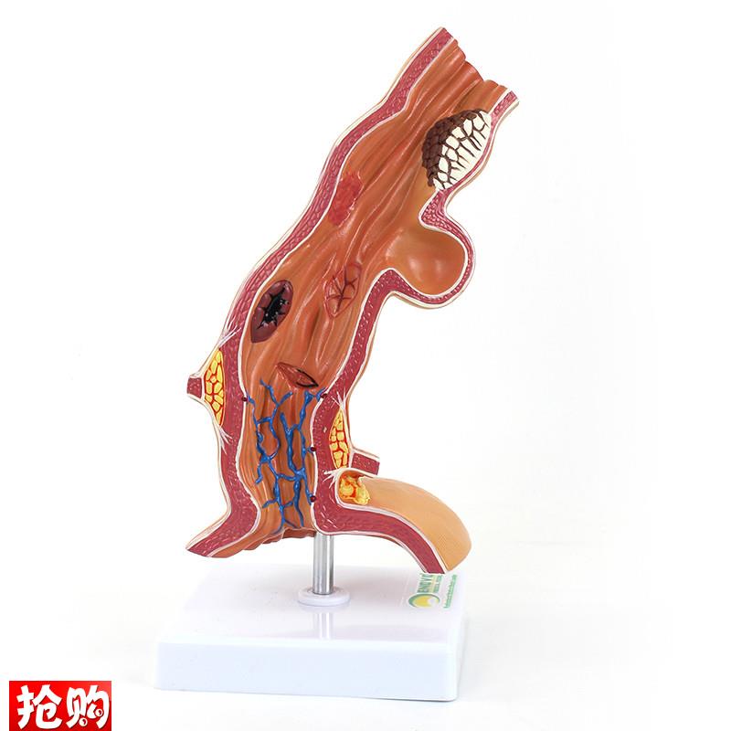 ENOVO颐诺人体m食管疾病理模型医院消化科教学医患沟通解剖模型食