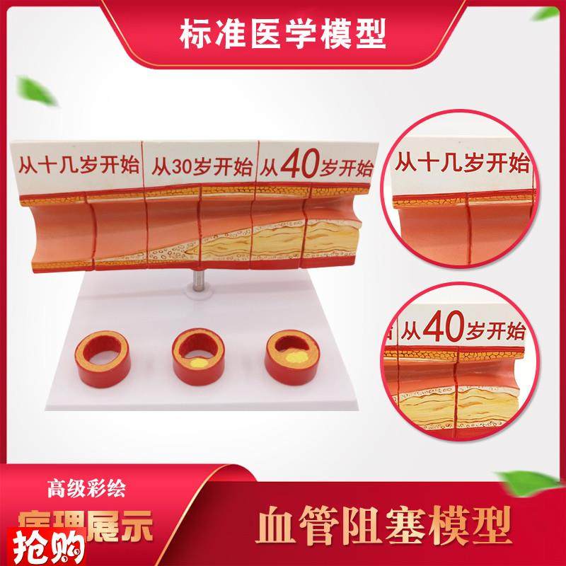 人体血管模型动h脉血管阻塞变化演示教学模型器官解剖结构层次模