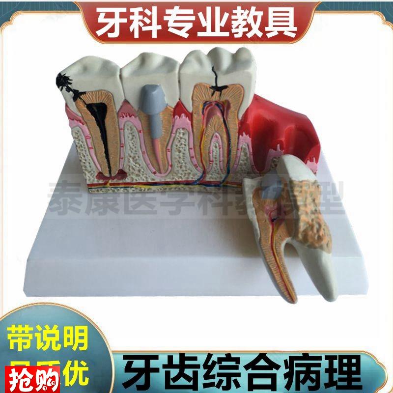 病理牙齿模型切牙尖牙磨牙臼齿牙科口腔牙龈根管牙髓W龋齿蛀牙虫