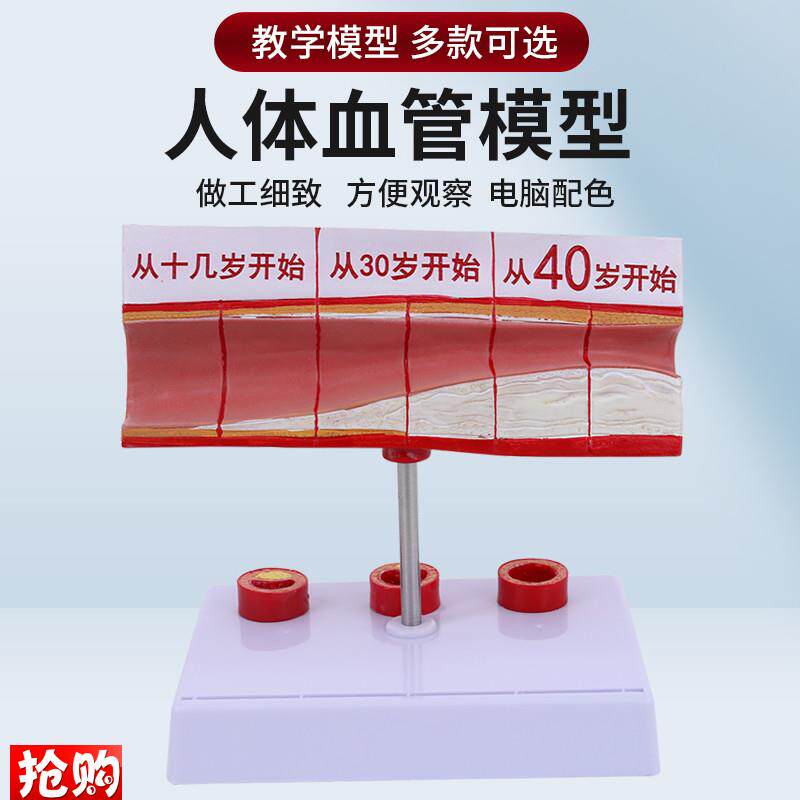 人体血管解剖模型血p管模型硬化动脉展示各阶段年龄层血管演示