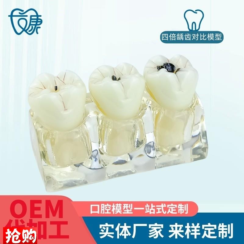 牙模型牙科口腔教学p模型窝沟封闭模型龋齿对比模型龋齿模型