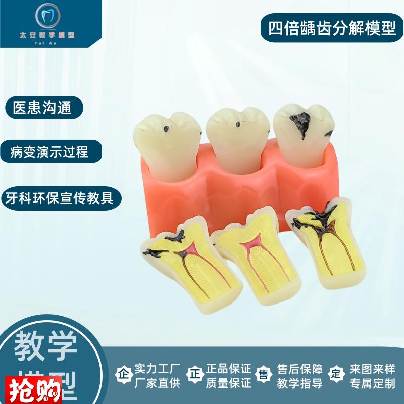 牙模型牙科口腔教学模型窝沟封闭模型龋齿对比模.型龋齿模型