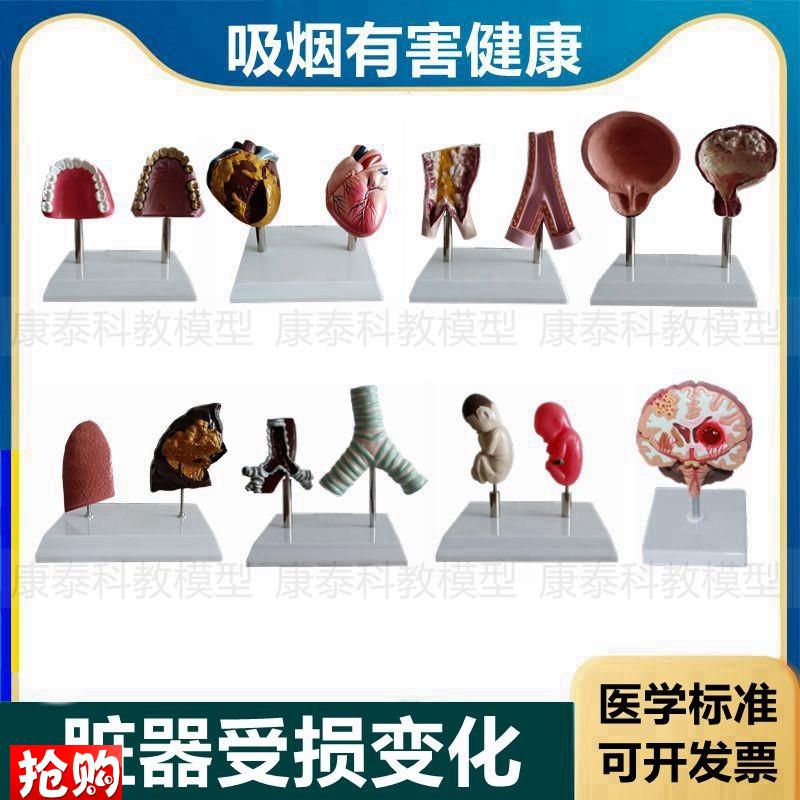 心脏模型病理正常对比吸烟u有害心血管肺气管口腔牙齿戒烟警示教