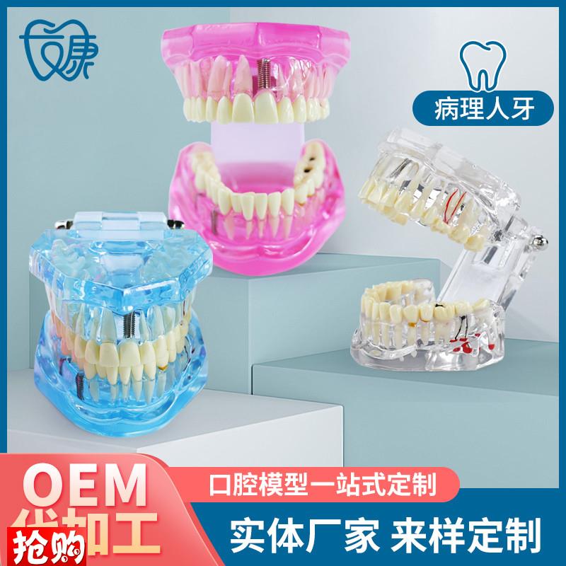 牙齿模型病理修复可拆q卸正畸口腔病理牙模型牙科医患活动沟通