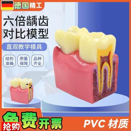 德国】六倍龋齿对比模型口腔牙齿模型口腔教学蛀牙Z切面模型牙