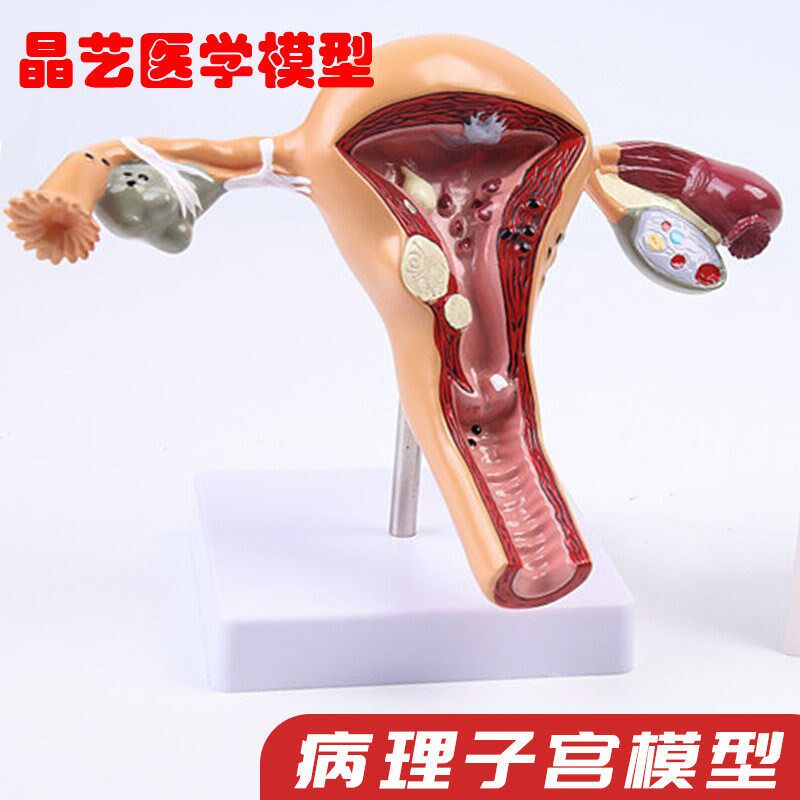 女性生殖病理子宫模型 中医教学用子F宫模型 科学教具塑胶子宫模