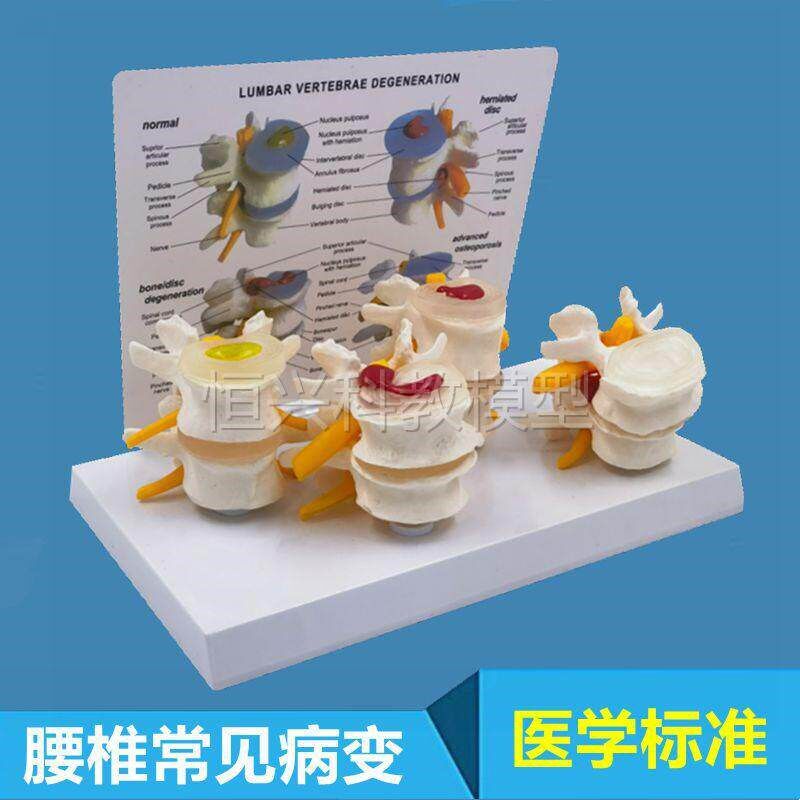 脊柱脊椎结构小针刀骨科腰椎对比椎间盘突T出脱出演示模型