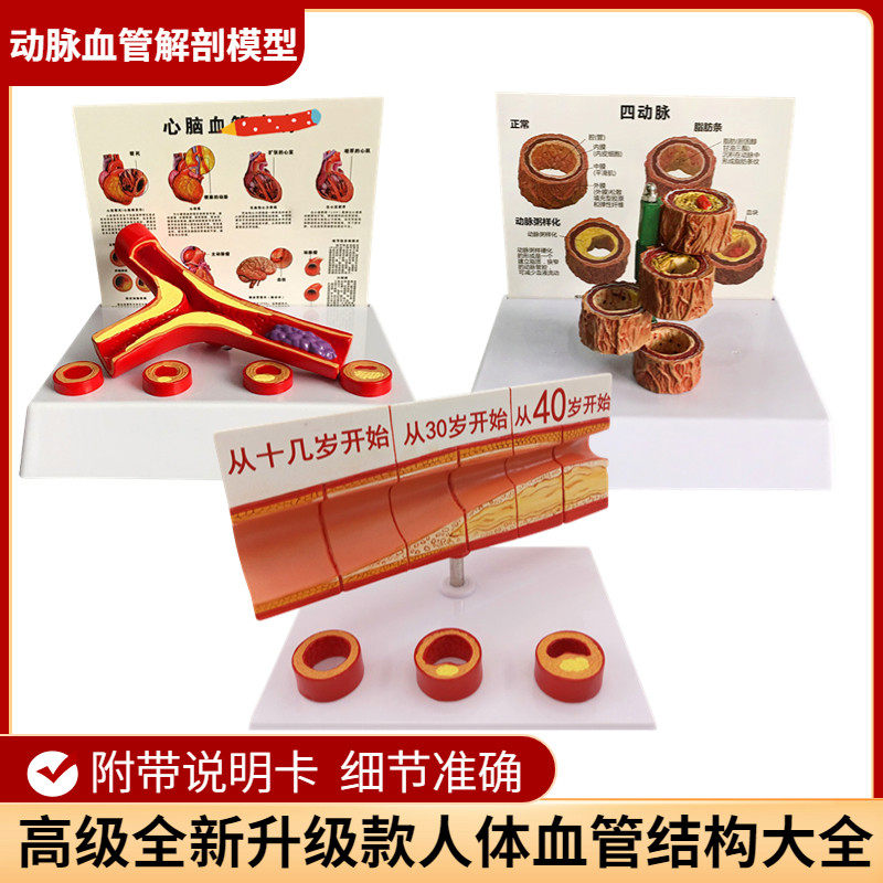 血管/堵塞动支脉粥样/硬t化心血管动脉/ 硬化模型血管病理模型血
