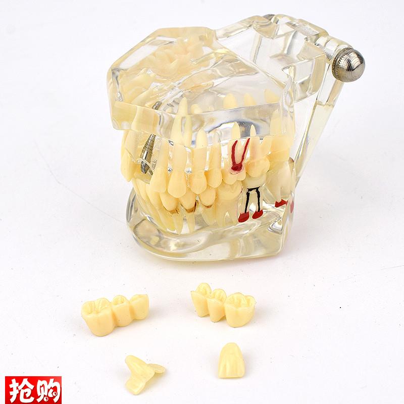 ENOVO颐诺口腔模型齿科种植阻生齿F牙体牙髓口腔教学马里兰桥瓷贴
