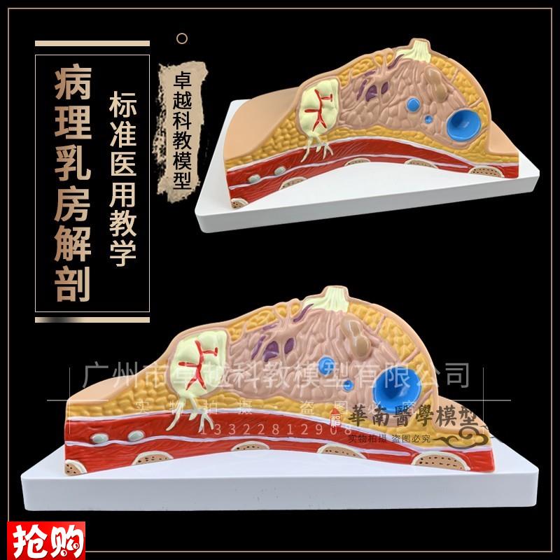 包邮教学病理乳房模型乳腺病变模型乳房解剖模型S人体乳房素描标