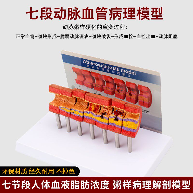 仿真人体心脑血管动脉粥样硬化堵塞E模型血栓血液脂肪病理解剖教
