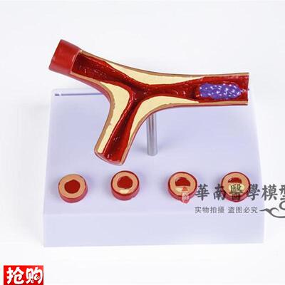 人体支脉粥样=硬化血栓=形成=模型血管模型血液V科动脉=化模型