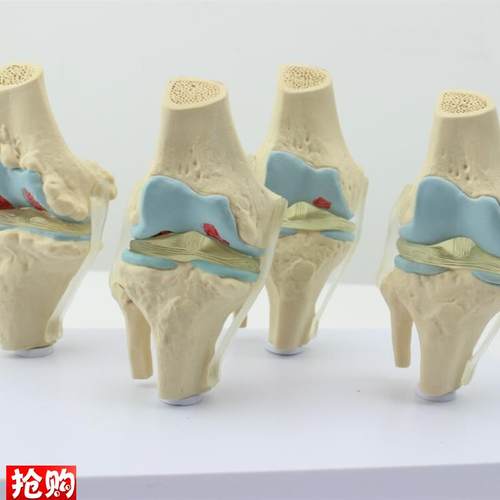 ENOVO颐诺人体病理膝关v节模型退行性血友病模型骨科管骨骼模型膝