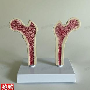 康泰医学模型股骨密度变r化骨质疏松比较长骨干解剖健康病变腿骨