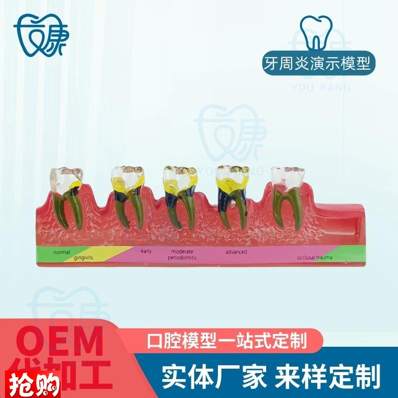 牙科口腔教学模型牙周炎模型牙周炎演变P模型牙科口腔教具