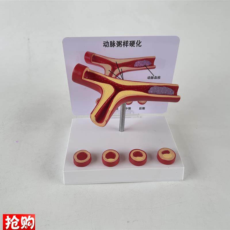 人体血管病理粥样动脉/硬化模y型病变血栓/血管/病演示心解剖教具