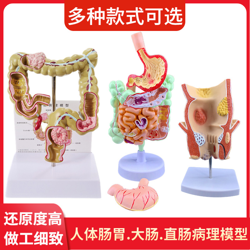 大肠病理模型直肠模型肠胃病变解剖模型肠道疾病人体结Z肠病变模
