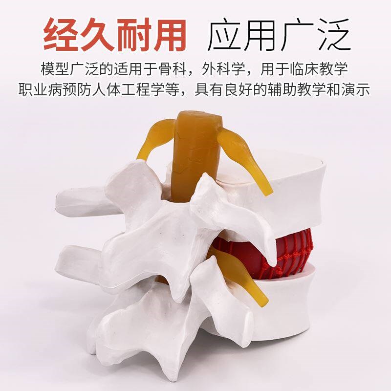 医学腰椎间盘受压演示模w型 脊柱脊椎病理侧压突出教具