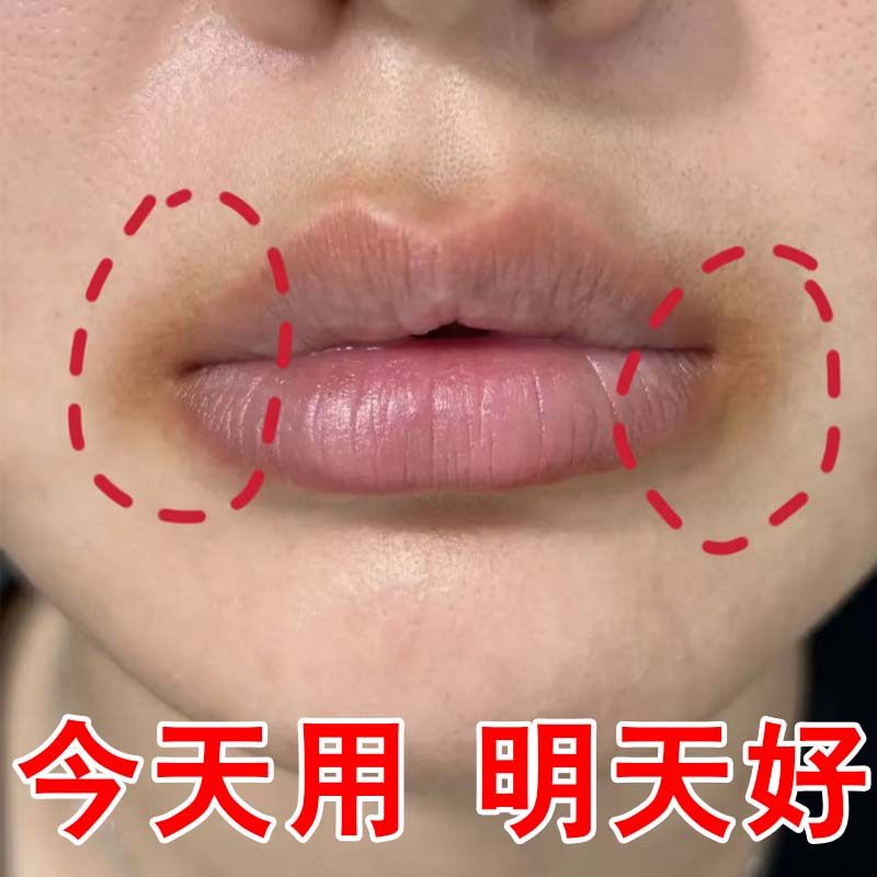 改善唇周黑嘴唇黑色素沉淀去除嘴角暗沉贴嘴巴周边死皮淡化唇膏