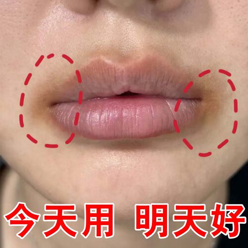 改善唇周黑嘴唇黑色素沉淀去除嘴角暗沉贴嘴巴周边死皮淡化唇膏