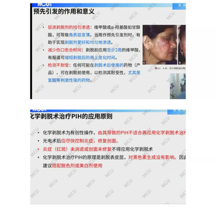 痘印色沉预防痘坑疤痕治疗色素病列治疗与化学剥脱素后预防教程
