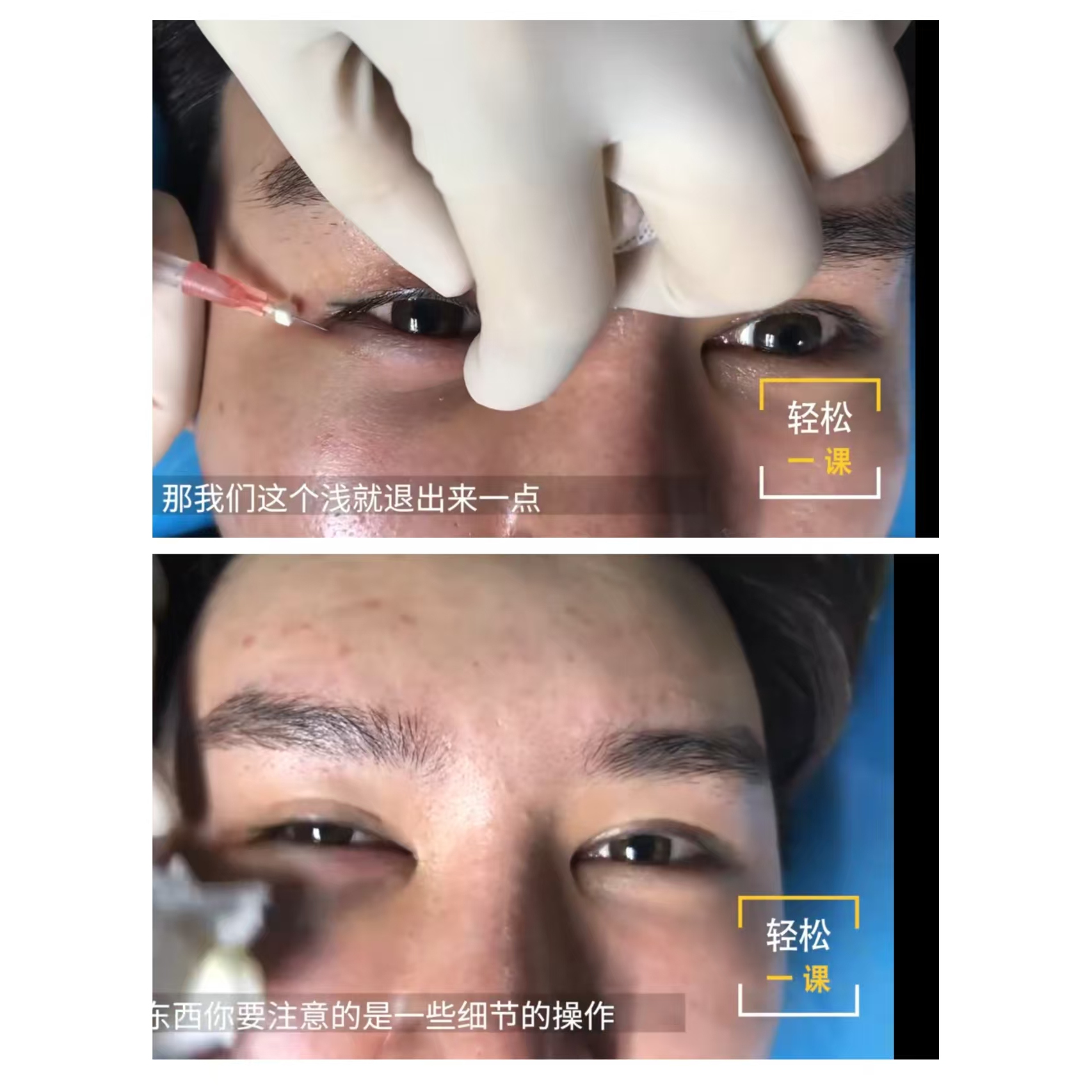 杨威线雕小线卧蚕提升下颌线改善黑眼圈V脸紧恋线面部精细化打造