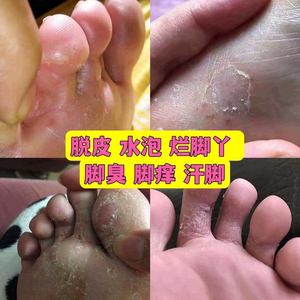 脚气 （1）脱皮水泡脚痒烂脚丫脚臭脚汗抑菌喷剂抑菌乳膏
