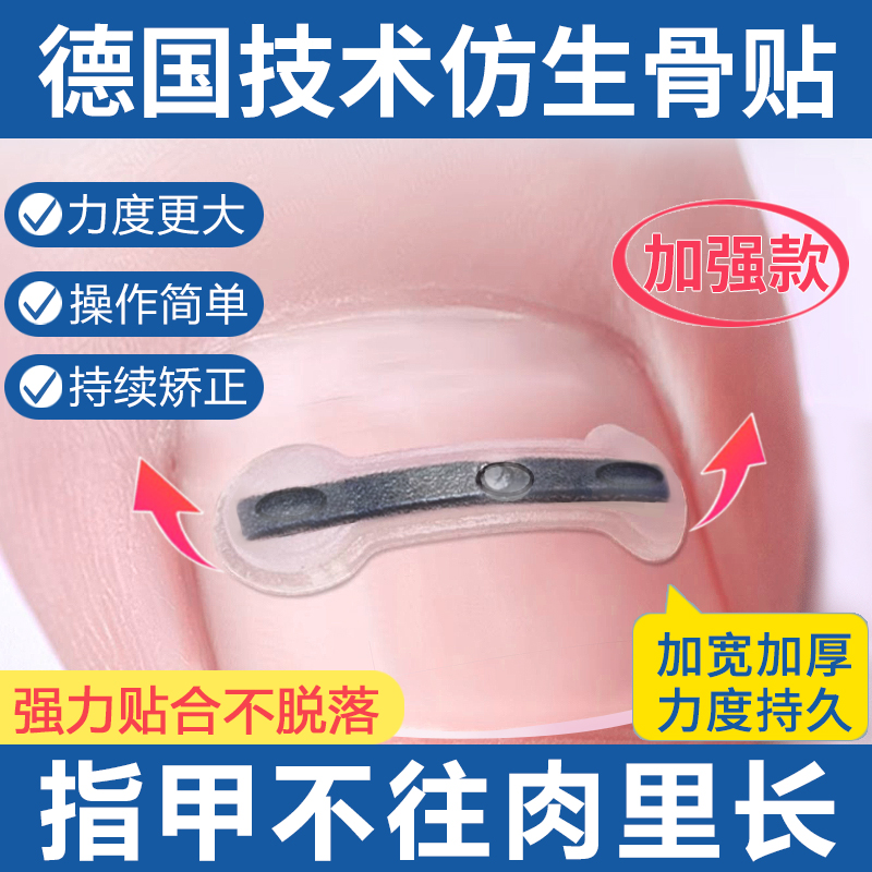 德国钛合金弹片甲沟嵌甲矫正器正甲贴脚趾指甲往肉里长专用神器炎