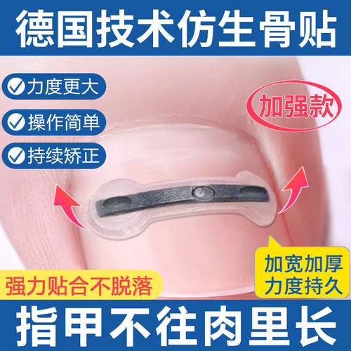 德国加宽钛合金弹片专治嵌甲力大