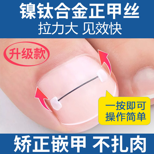 升级版镍钛合金正甲丝力大见效快