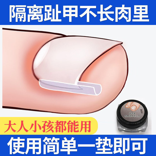 正甲垫嵌甲矫正隔离指甲甲沟炎