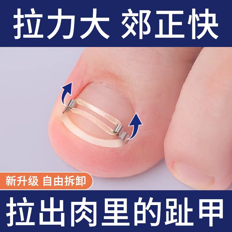 正甲扣甲沟嵌甲矫正器炎脚趾甲往肉里长提拉牵引器正甲贴拉拉贴钩