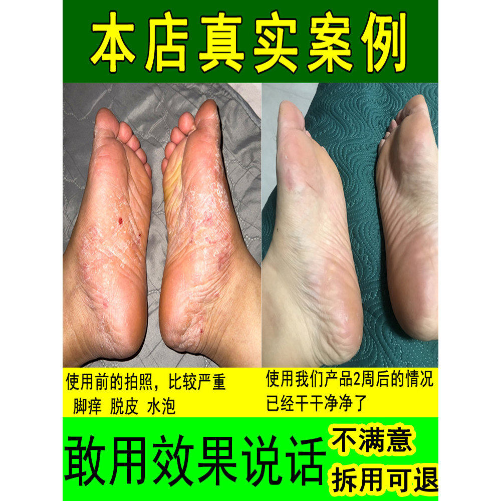 脚止气痒脱皮杀菌喷雾去烂脚丫膏治除脚趾缝糜烂神器专用膏