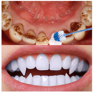 正品】[不白包退]买2发3黄牙烟渍牙茶渍牙结石牙垢克星去除口臭清