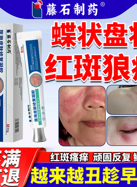 慢性盘状蝶状红斑狼疮治系统离心性红斑外用软膏皮肤疙瘩痒神器SK