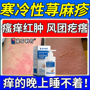 寒冷性慢性寻荨麻疹冷空气过敏抑菌止痒沐浴露断风团疙瘩瘙痒根SK