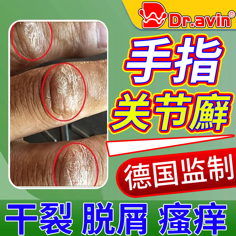 手指关节癣真菌感染手癣脱皮干裂硬皮疙瘩特指节垫效可搭配药膏vm