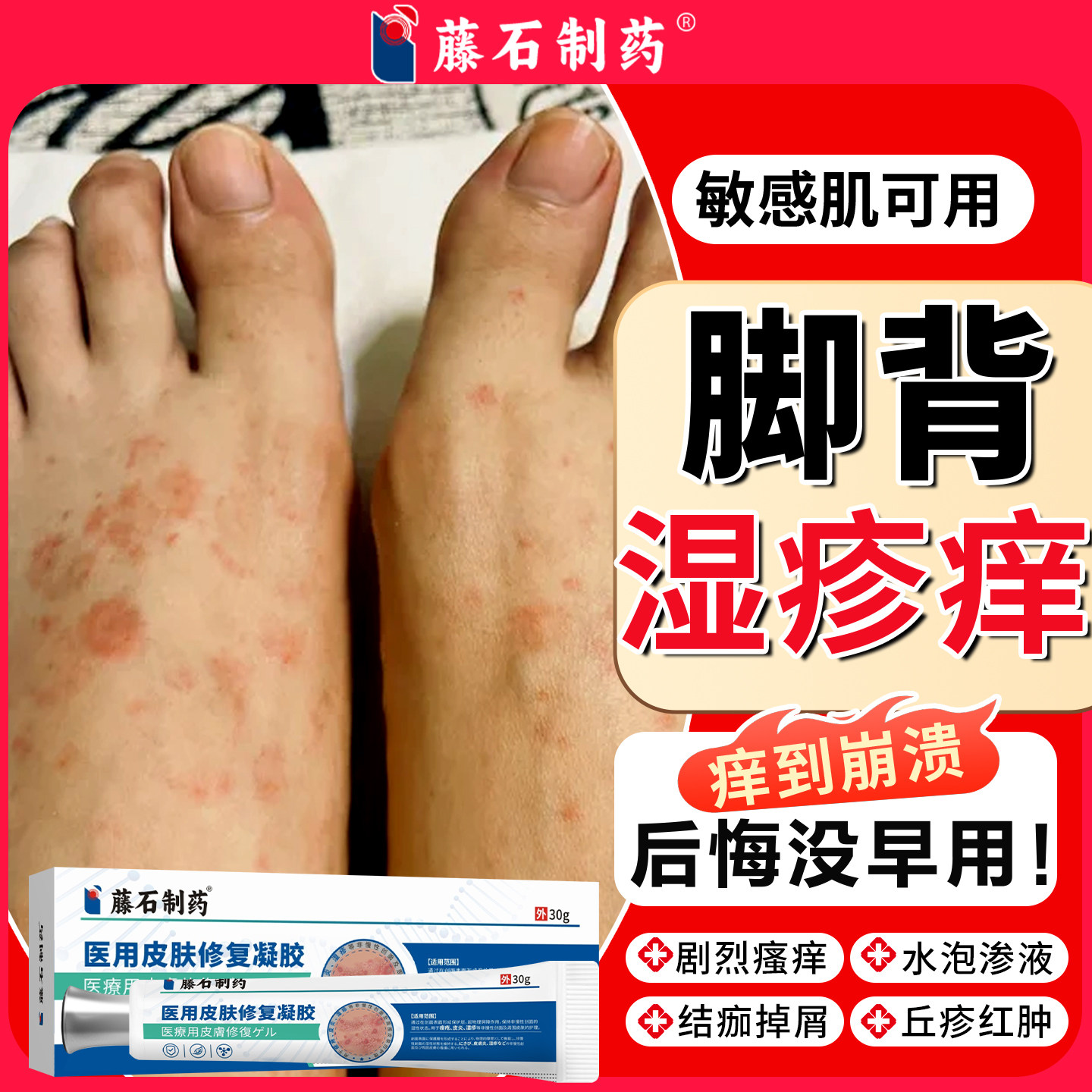 脚背湿疹瘙痒脚上水泡止痒脚底脚踝去真菌感染根脚癣药房同款膏SA