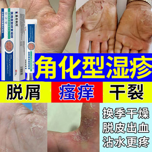 角质角化型湿疹手癣膏医用真菌感染手掌粗糙干裂药房同售膏SK