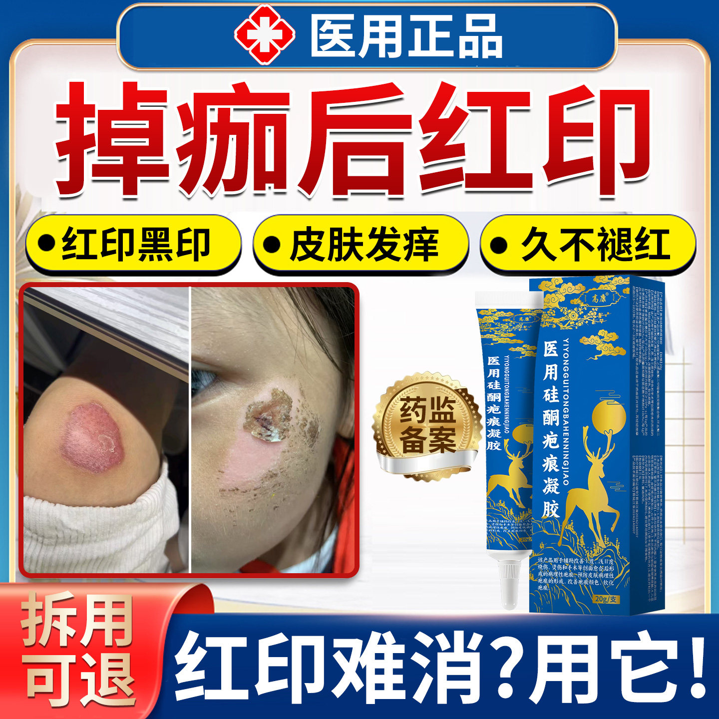 掉痂后红印疤痕修复除疤膏摔伤擦伤结痂祛疤去黑印色素沉淀QG图片