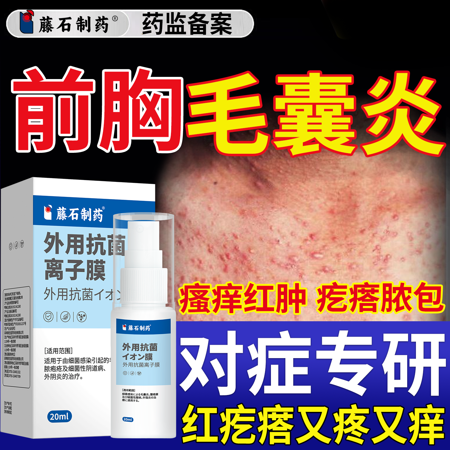 前胸后背长痘痘毛囊炎喷剂马拉色菌药房同售膏手臂长疙瘩瘙痒N6