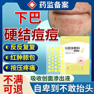 下巴反复长痘痤疮膏红肿硬块痘痘闭口粉刺淋巴腮边痘红肿脓包贴VX