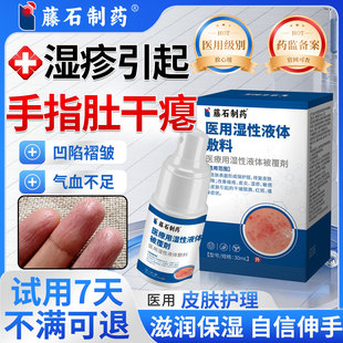 手指肚干瘪角化型湿疹手癣膏手指干裂蜕皮指腹凹陷褶皱真菌感染SK