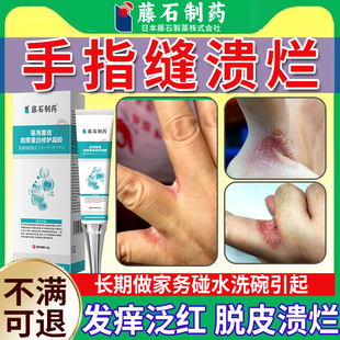 洗碗碰水手指缝溃烂痒药房同售膏烂手手气脱皮开裂止痒真菌感染QK